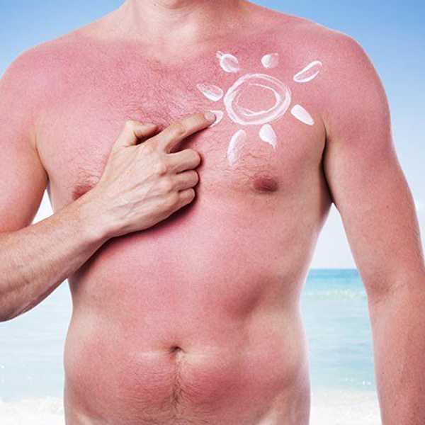 Struggles Of Pale Skin In Summer