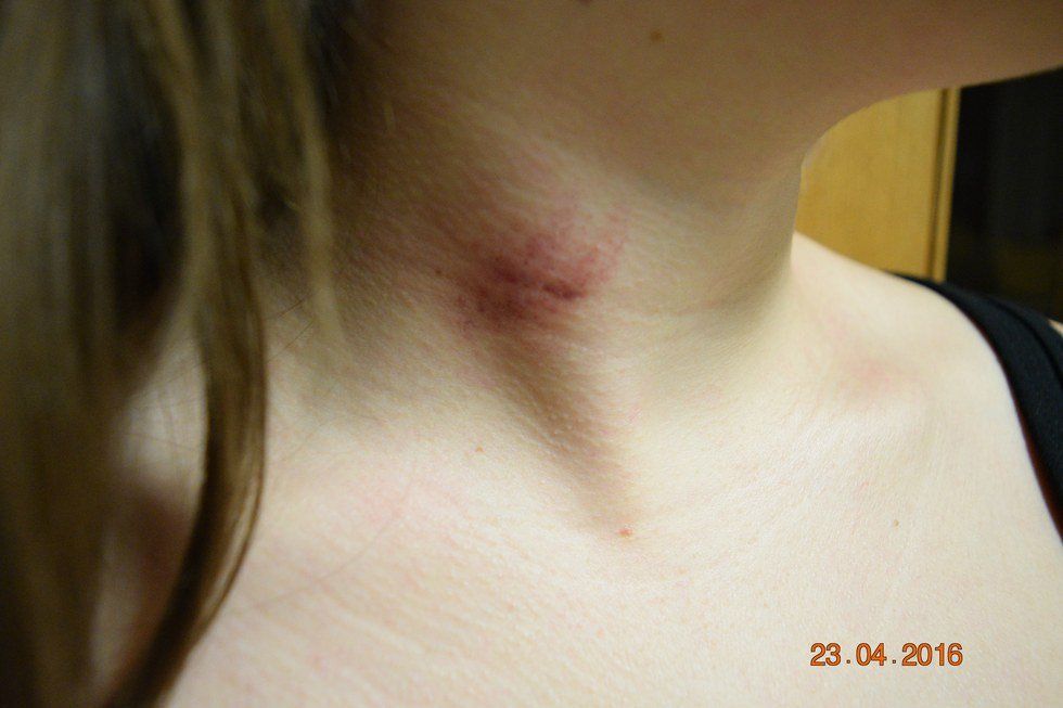 Why Are Hickeys So Unacceptable?