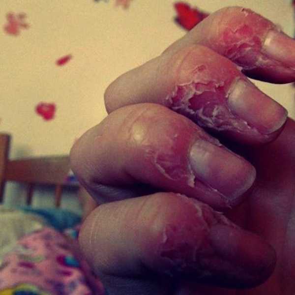 Living With Excoriations Disorder
