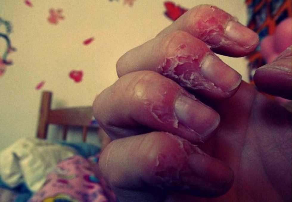 Living With Excoriations Disorder