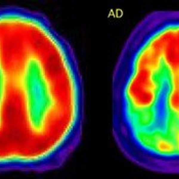 5 Things That ADHD Is Not