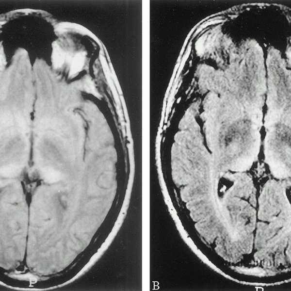 Kuru: A Disease That Can Be Caused By Cannibalism