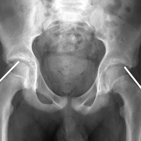 My Experience Living With SCFE