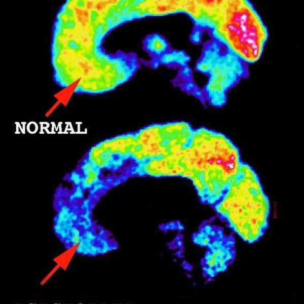 What Makes Someone A Psychopath?