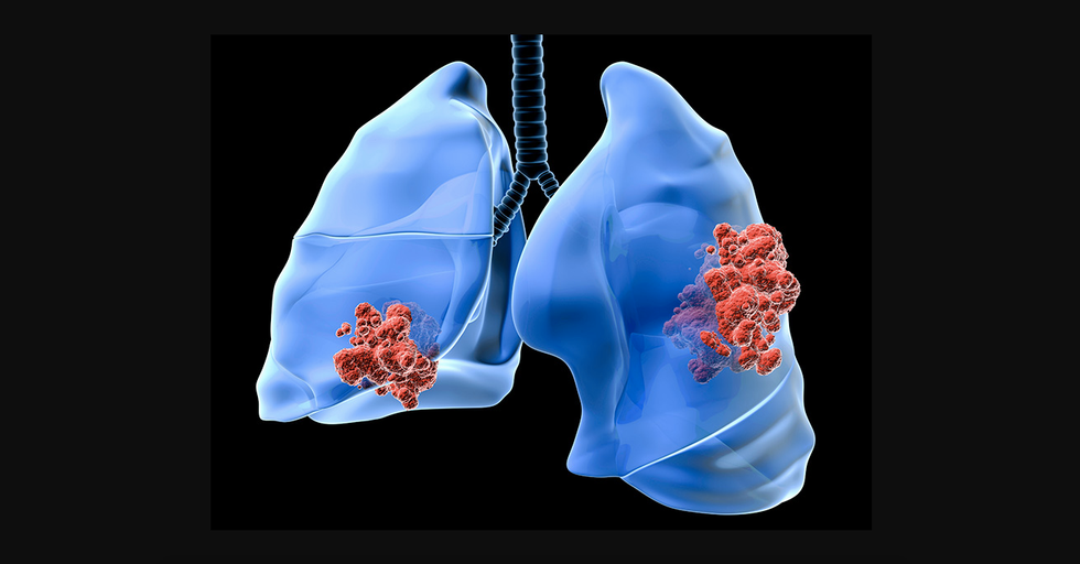 In and Outs Of Lung Cancer