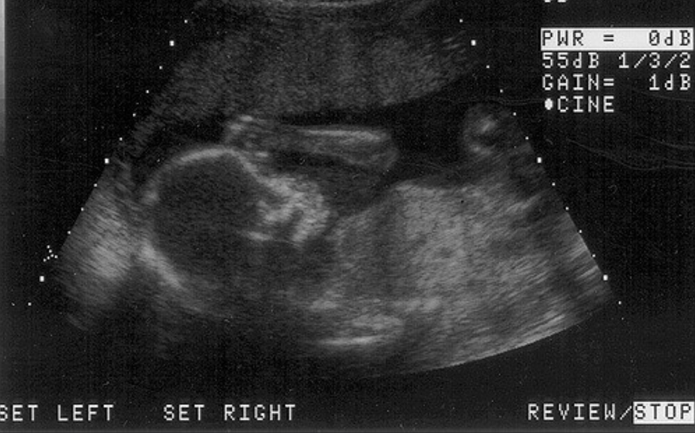 I Will Always Be Pro-Life, And You Should Be, Too