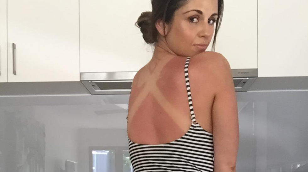 8 Tips And Tricks For Conquering A Bad Sunburn