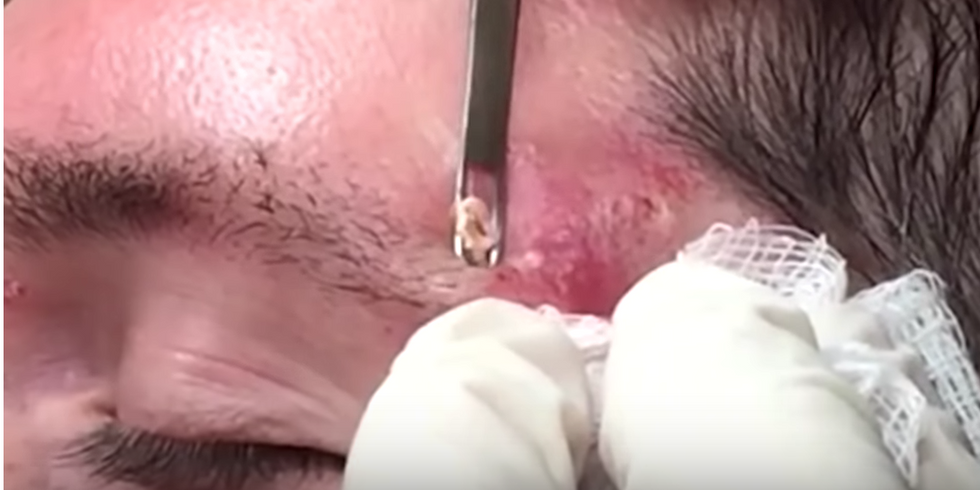 Dr. Pimple Popper Pops Everything From Cysts, Blackheads, And Acne And It Is So Satisfying To Watch