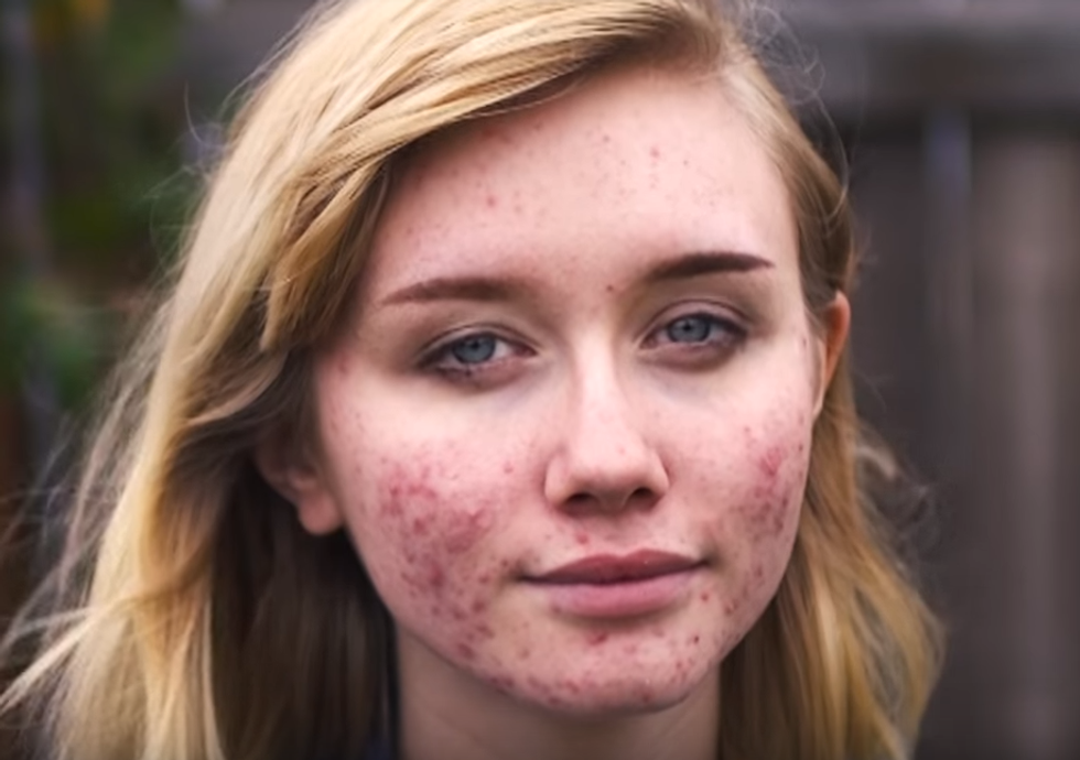 The Only Thing I Cover My Acne Up With Is Self-Love