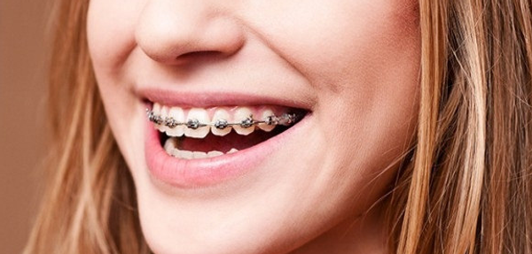 Asking People What It Is Like To Have Braces As An Adult