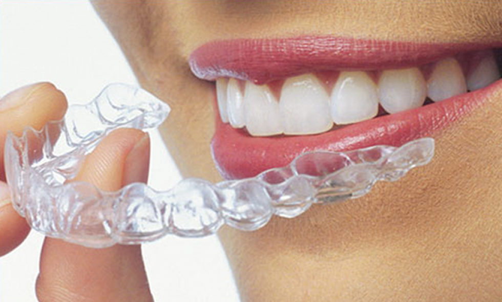 5 Advantages of Clear Aligners over Traditional Braces