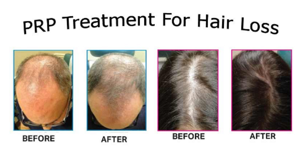 Do You Know How PRP Hair Treatment Can Work As An Innovative Hair Restoration Technique