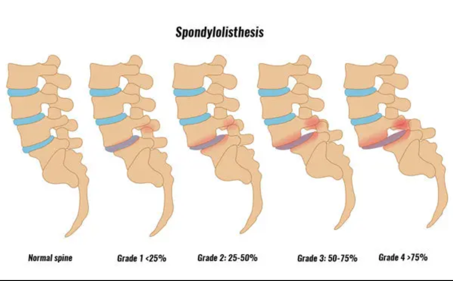 What is Spondylosis, and How can you manage Spondylolisthesis Pain?