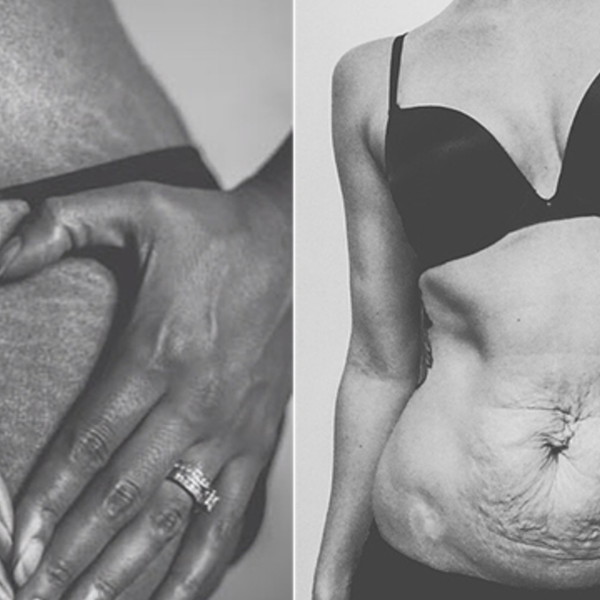 Stretch Marks: A Map of My Body's Journey