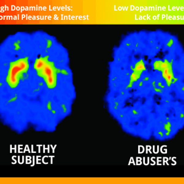 Addiction And The Brain: Why Addiction Is A Disease