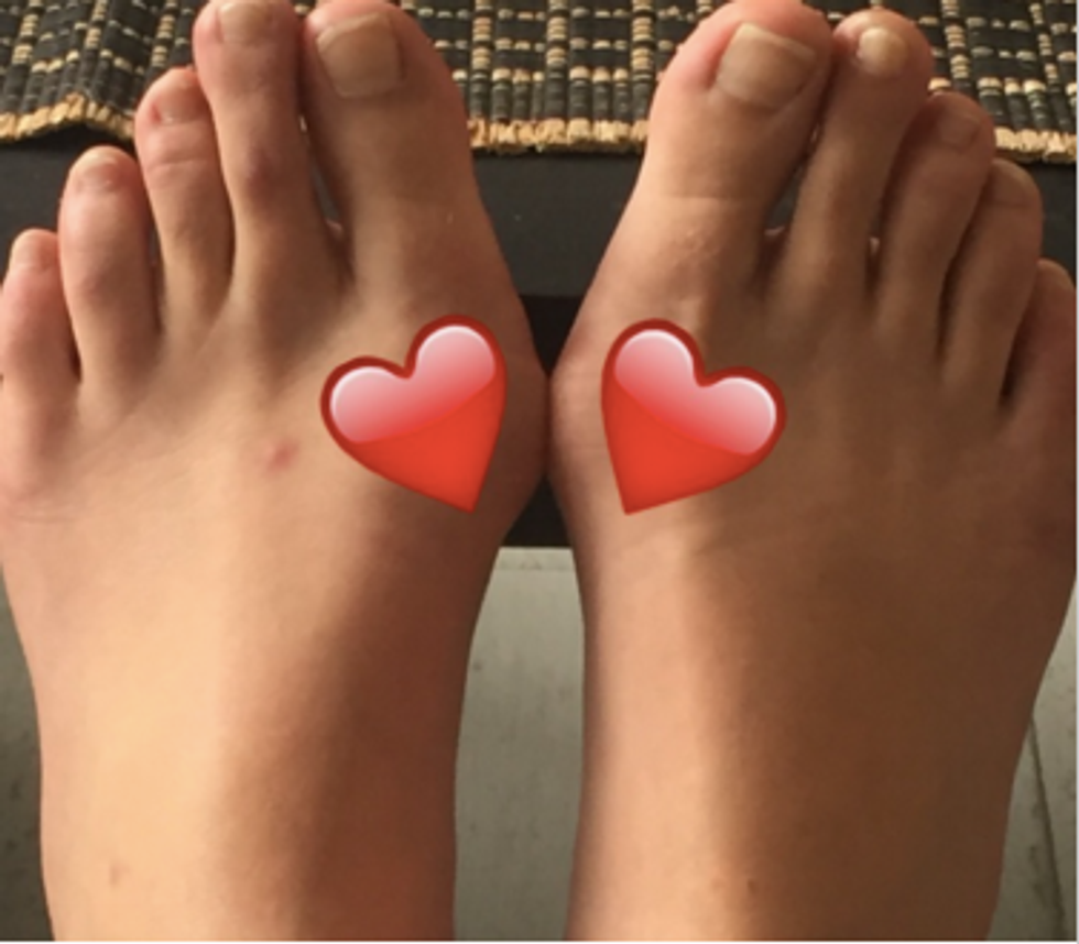 Ode To My Bunions
