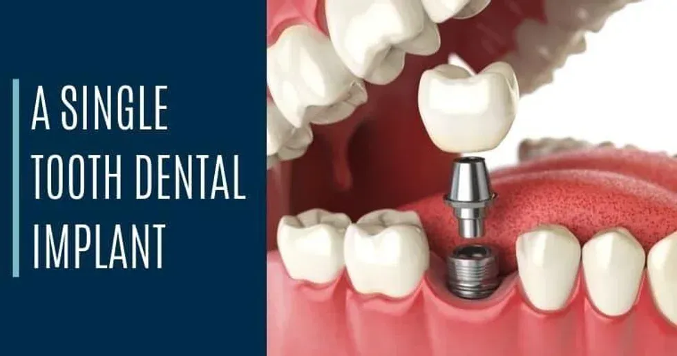 Dental Implants - A Simple Guide To Restoring Teeth