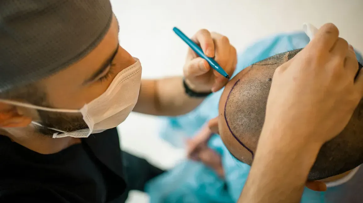 At Root Level: How Does a Hair Transplant Actually Work?