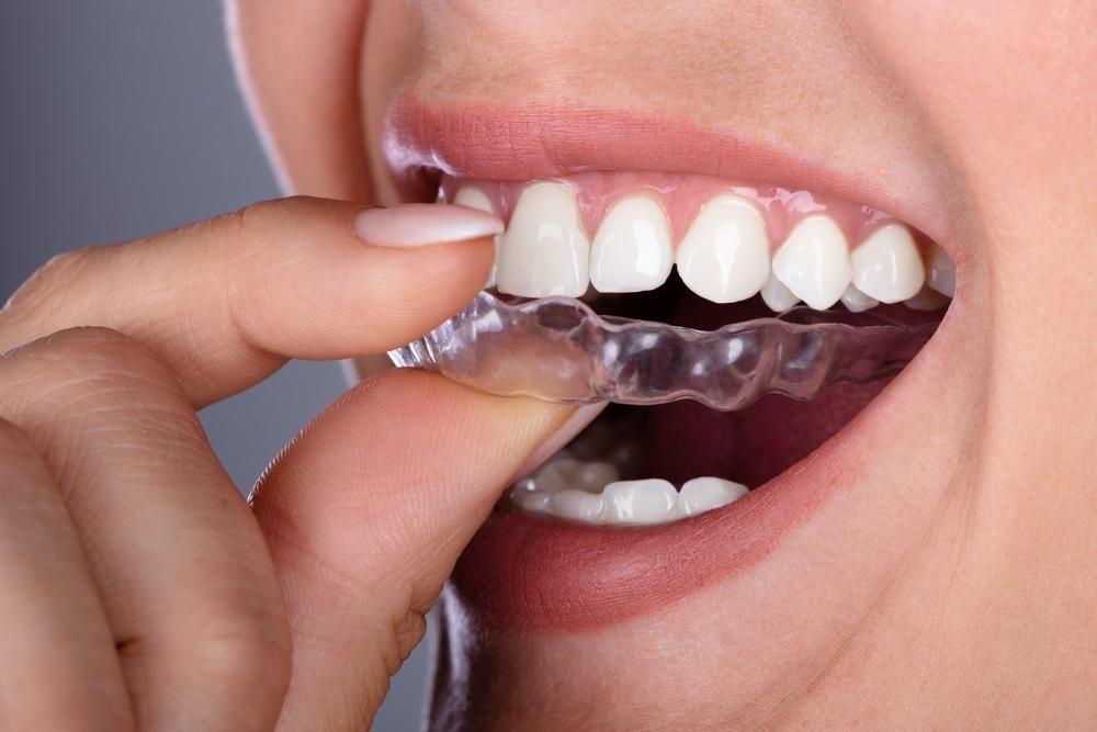 Invisible Aligners