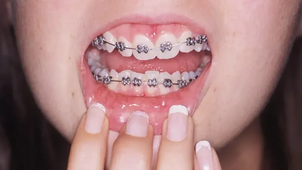 Petty things to wish for your enemy: get brackets